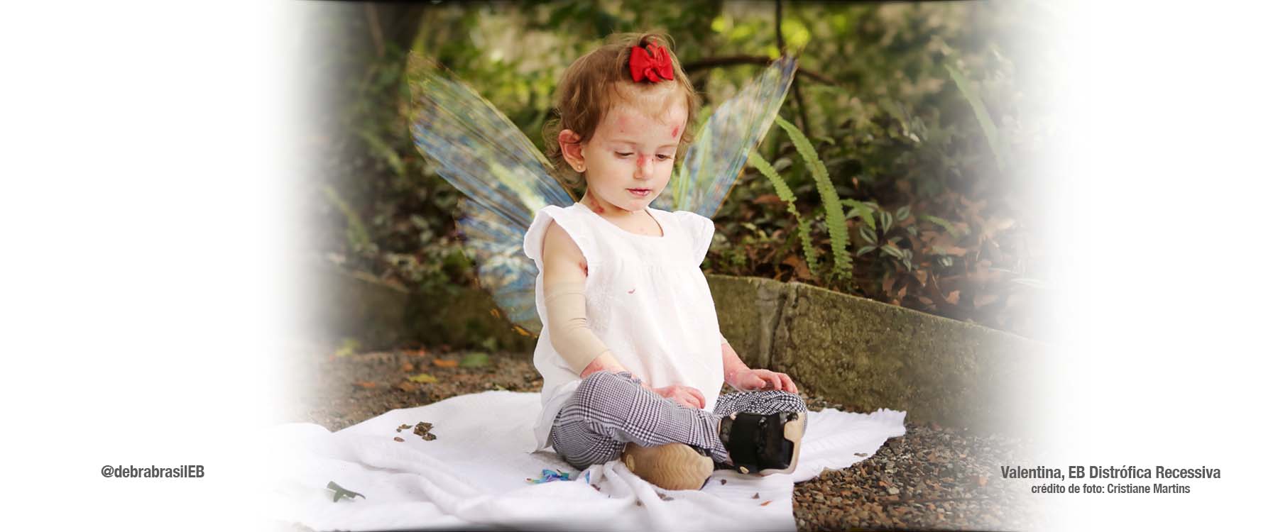 Valentina, bebê com epidermólise bolhosa (EB) distrófica recessiva, sentada com asas de borboleta nas costas