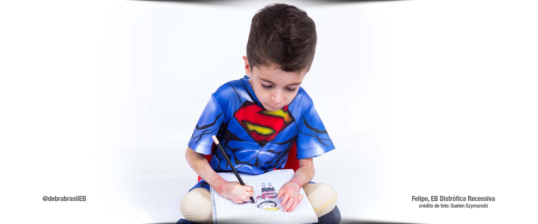 Felipe, menino com epidermólise bolhosa (EB) distrófica recessiva, está sentado de pernas cruzadas e desenhando