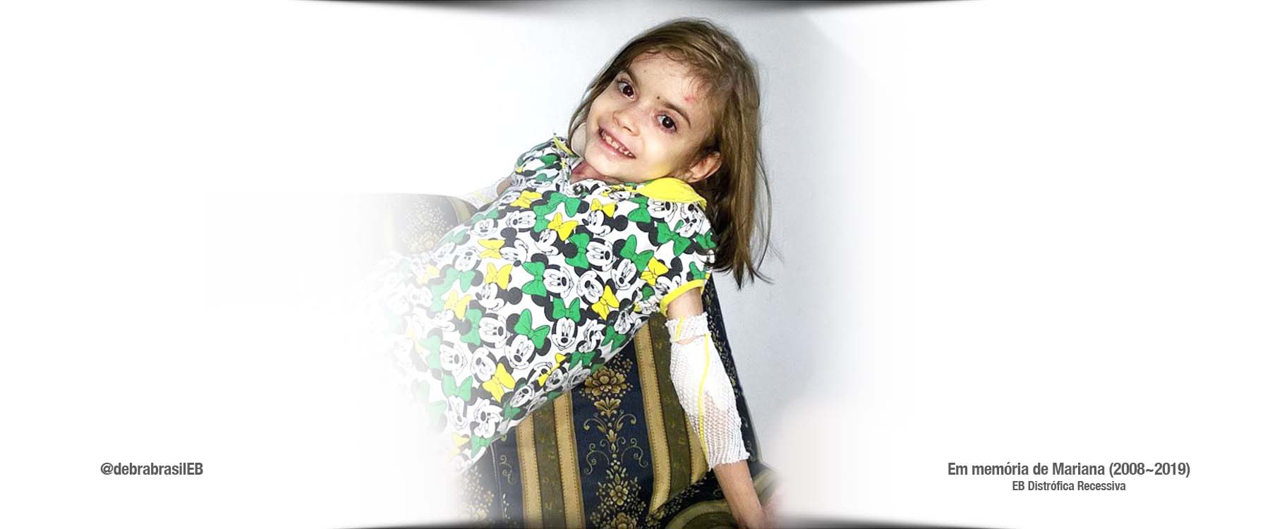 Mariana, menina com epidermólise bolhosa (EB) distrófica recessiva, dona do sorriso mais gostoso do mundo