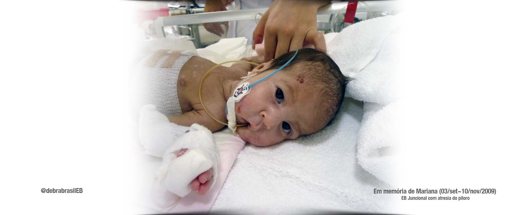 Mariana é uma bebê recém-nascida na UTI, com epidermólise bolhosa (EB) juncional com atresia do piloro
