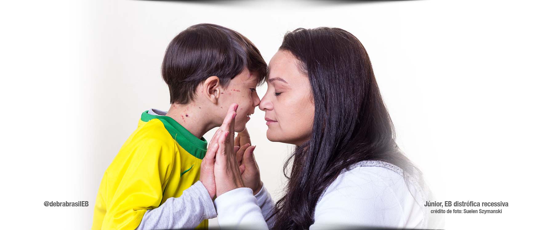 Júnior, criança com epidermólise bolhosa (EB) distrófica recessiva, veste a camisa da seleção brasileira ao lado da mãe