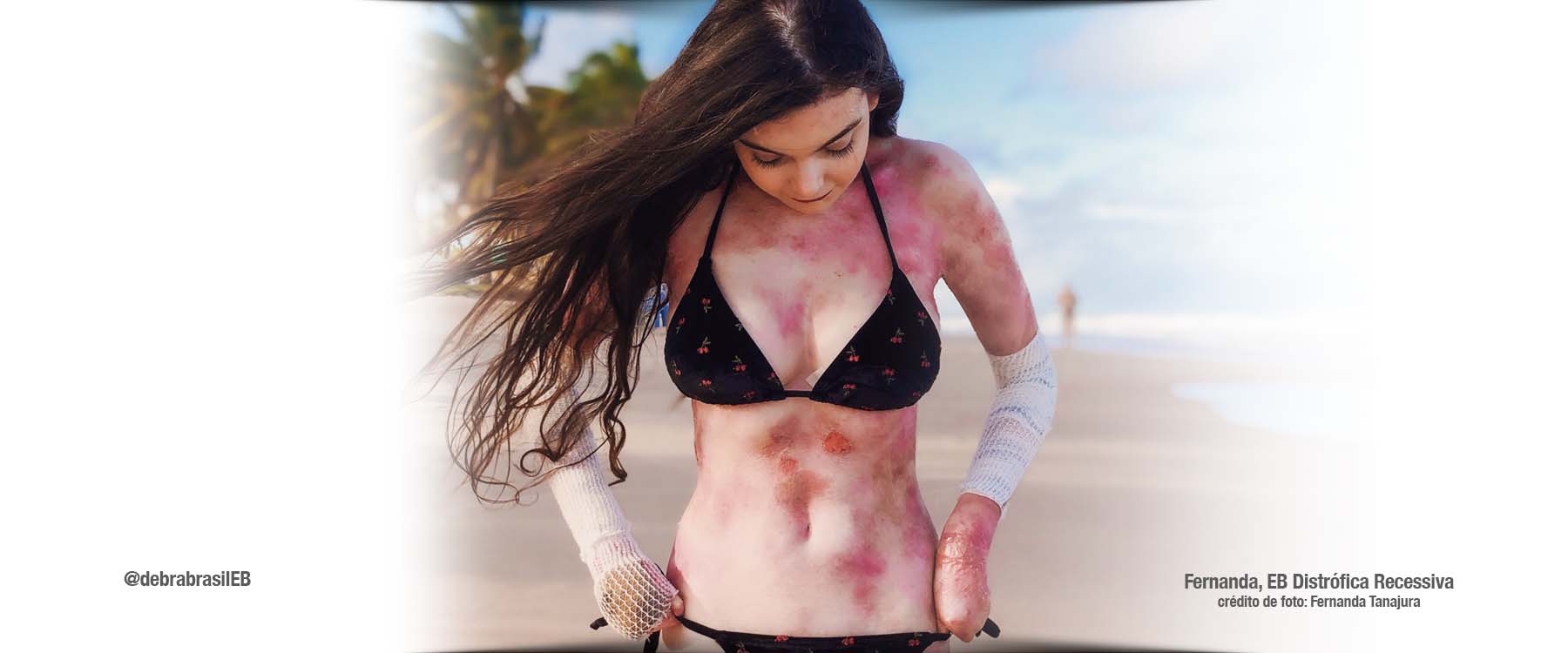 Fernanda Tanajura, uma mulher jovem com epidermólise bolhosa (EB) distrófica recessiva, vestindo um biquíni preto na praia